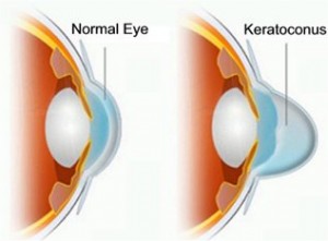 keratoconus
