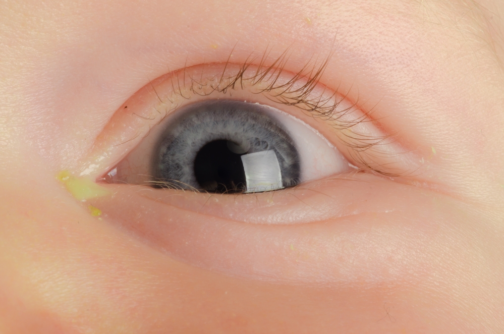Parents' Quick Guide to Pink Eye (Conjunctivitis) Pepose Vision