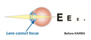 Illustrating Showing How the Eye Sees Before KAMRA Surgery