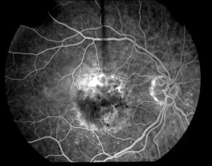 Scan of an Eye that Has Age-Related Macular Degeneration