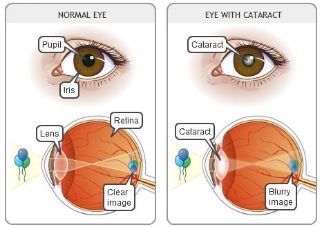Chart Illustrating a Normal Eye Compared to One With a Cataract