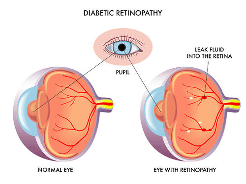 Chart Illustrating How Diabetic Retinopathy Affects the Eye