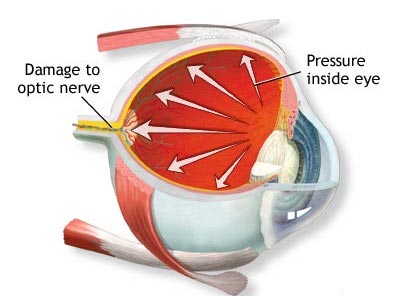 Image Illustrating How Glaucoma Affects an Eye