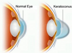 Chart Illustrating a Normal Eye vs One With Keratoconus