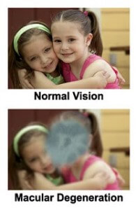 Chart Showing What It's Like to See With Normal Vision Vs What it's Like to See With Macular Degeneration