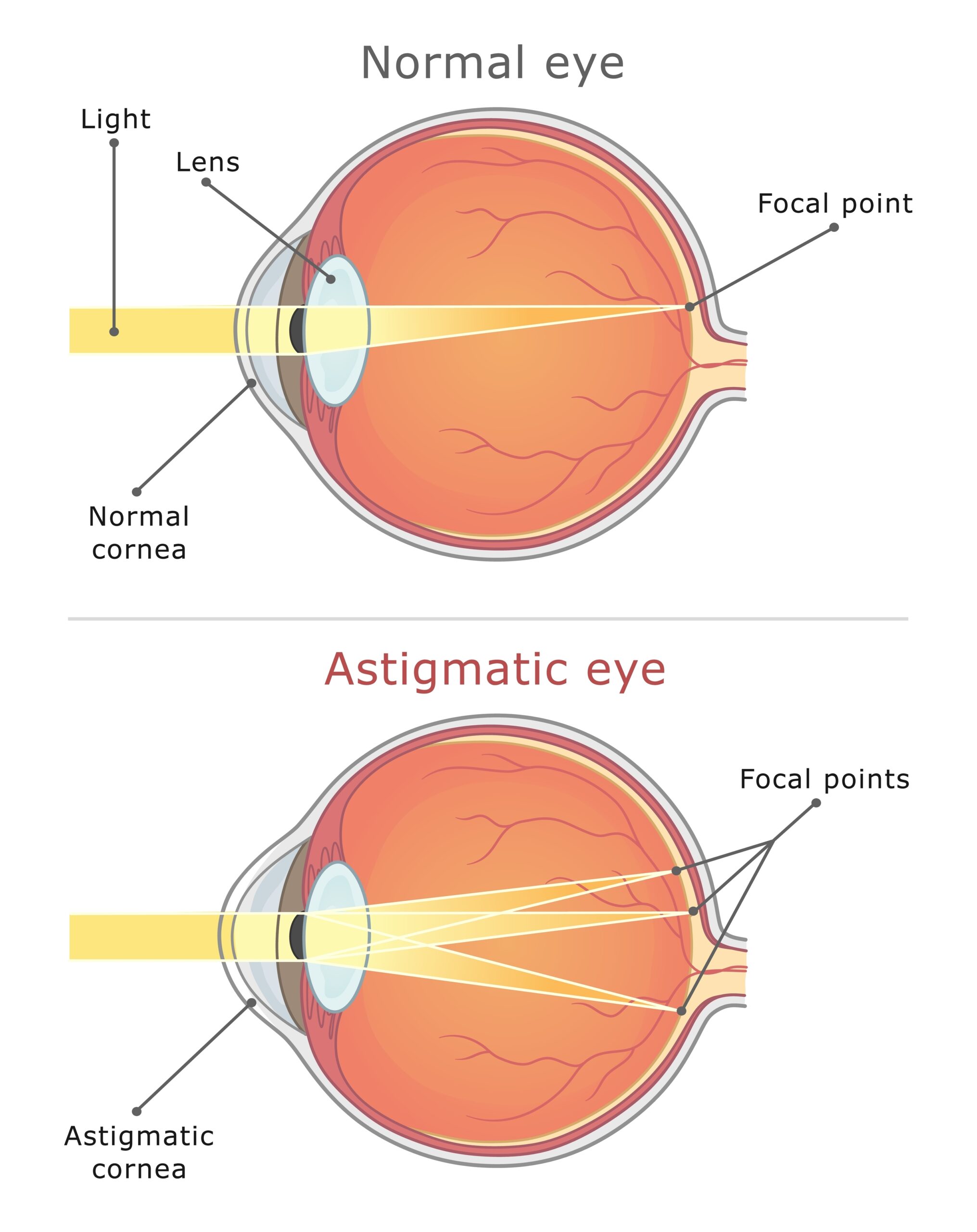 What is Moderate Astigmatism? Understanding Different Levels of ...