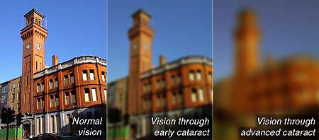 Diagram Showing What It's Like to See With a Cataract